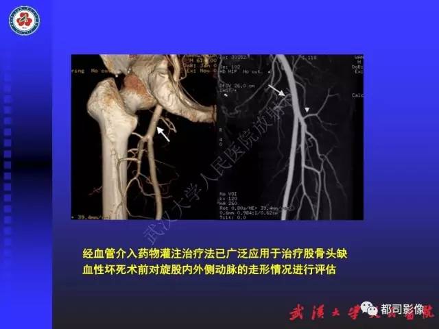 【PPT】下肢血管性病变CTA和MRA