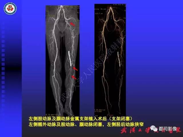【PPT】下肢血管性病变CTA和MRA