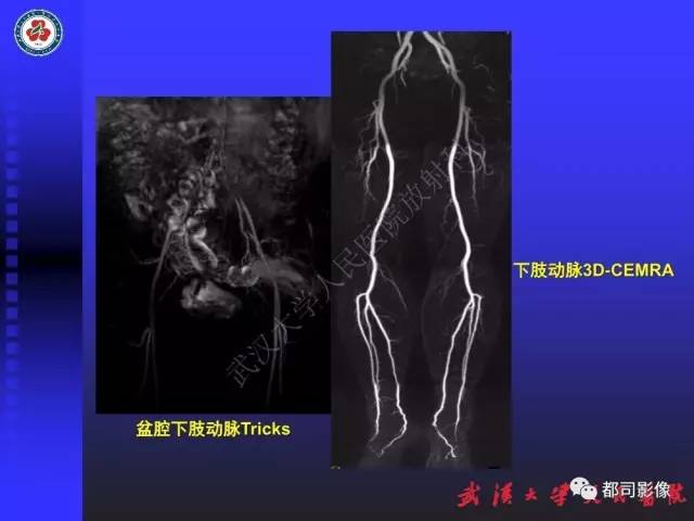 【PPT】下肢血管性病变CTA和MRA