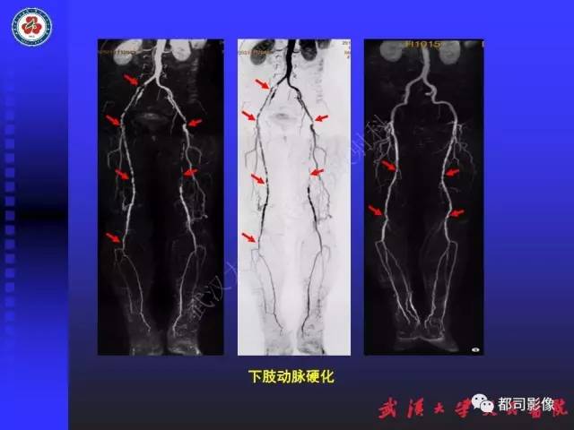 【PPT】下肢血管性病变CTA和MRA