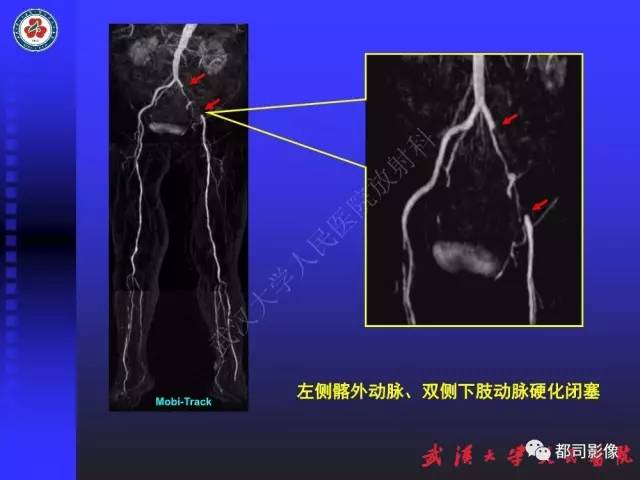 【PPT】下肢血管性病变CTA和MRA