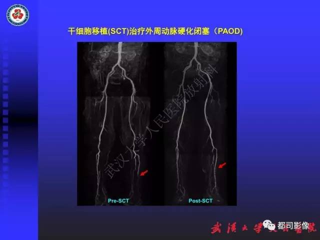 【PPT】下肢血管性病变CTA和MRA