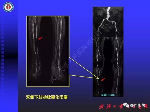 【PPT】下肢血管性病变CTA和MRA