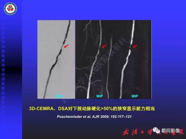 【PPT】下肢血管性病变CTA和MRA