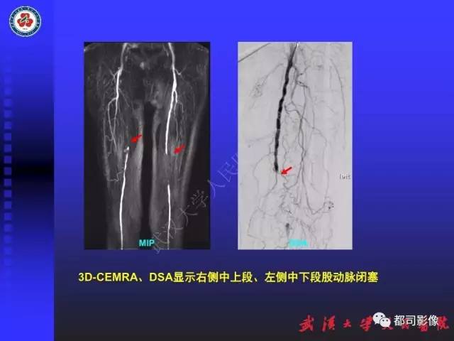 【PPT】下肢血管性病变CTA和MRA
