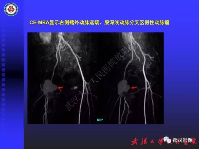 【PPT】下肢血管性病变CTA和MRA