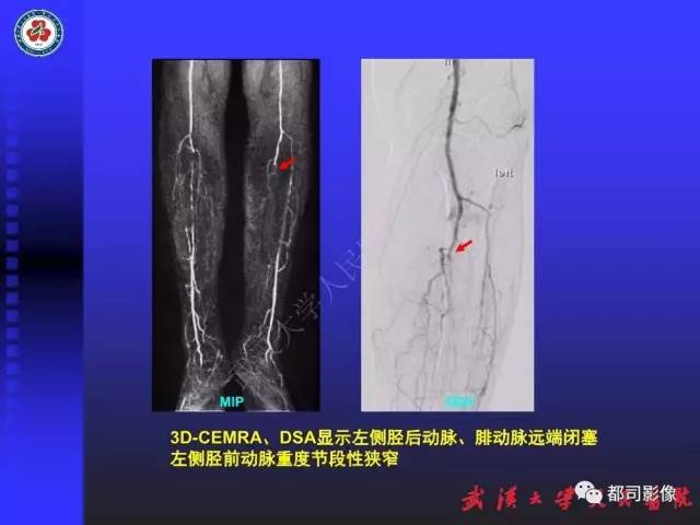 【PPT】下肢血管性病变CTA和MRA