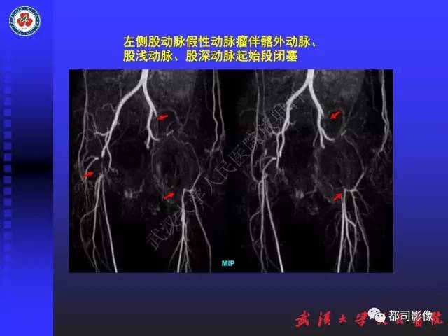 【PPT】下肢血管性病变CTA和MRA