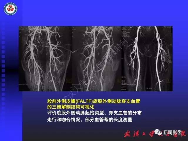 【PPT】下肢血管性病变CTA和MRA