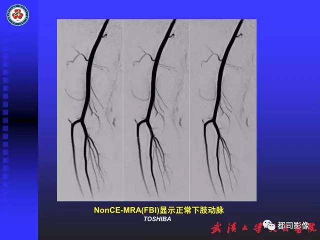 【PPT】下肢血管性病变CTA和MRA