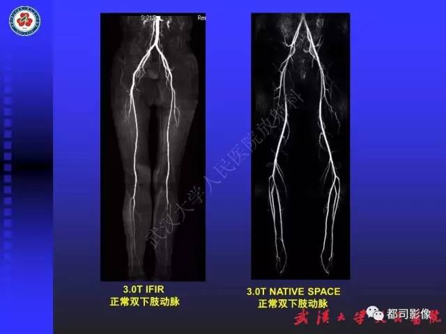 【PPT】下肢血管性病变CTA和MRA