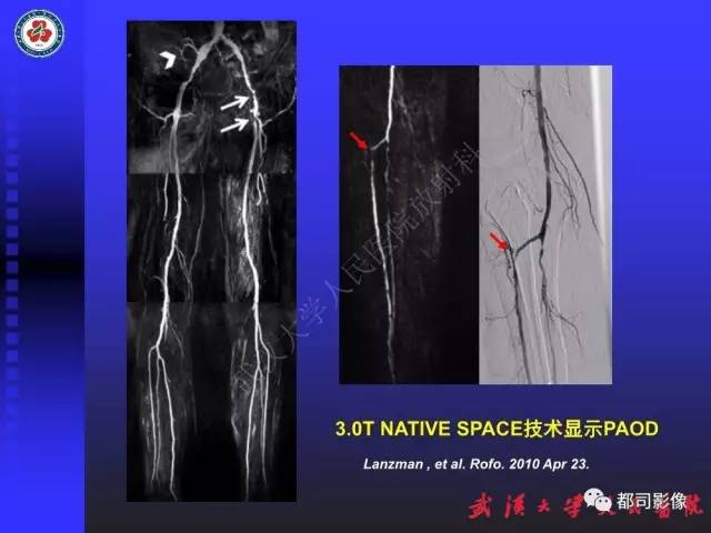 【PPT】下肢血管性病变CTA和MRA