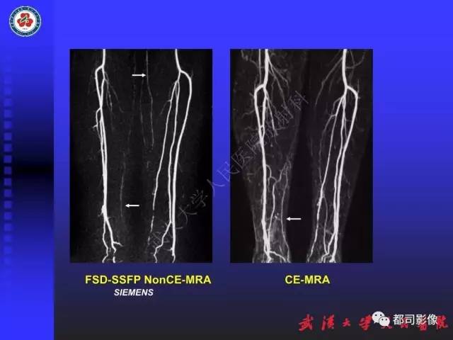 【PPT】下肢血管性病变CTA和MRA