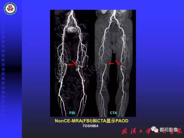 【PPT】下肢血管性病变CTA和MRA