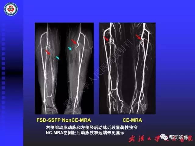 【PPT】下肢血管性病变CTA和MRA