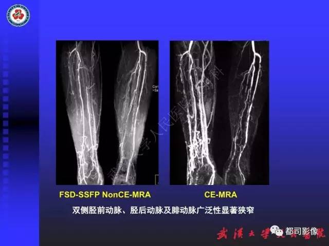 【PPT】下肢血管性病变CTA和MRA