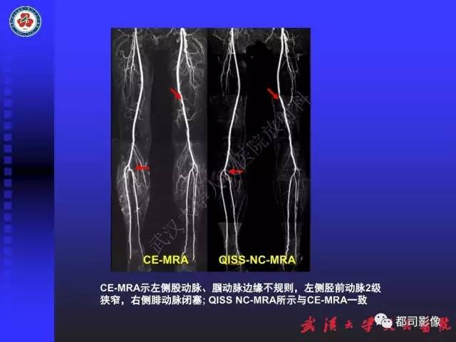 【PPT】下肢血管性病变CTA和MRA
