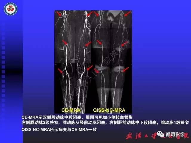 【PPT】下肢血管性病变CTA和MRA