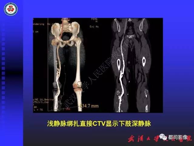 【PPT】下肢血管性病变CTA和MRA