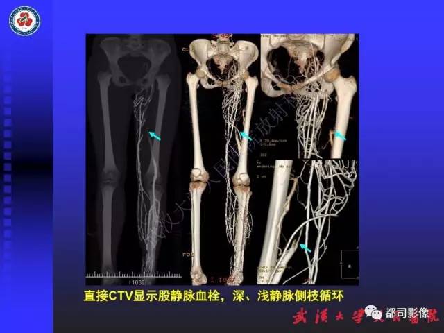 【PPT】下肢血管性病变CTA和MRA