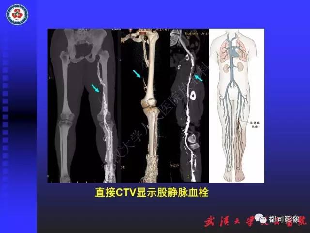 【PPT】下肢血管性病变CTA和MRA