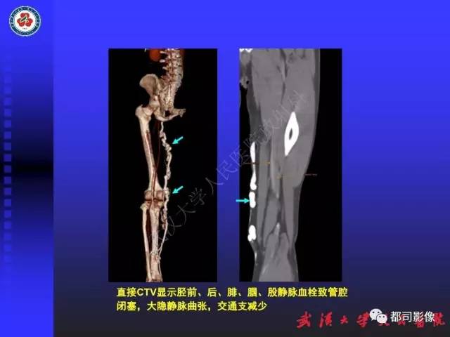 【PPT】下肢血管性病变CTA和MRA