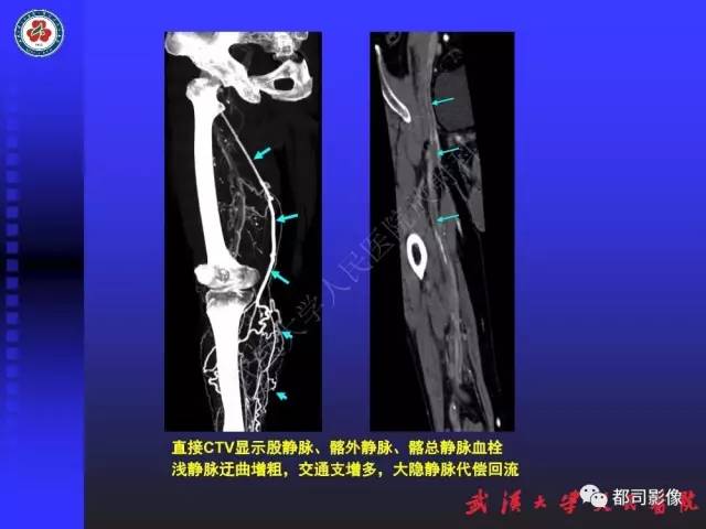 【PPT】下肢血管性病变CTA和MRA
