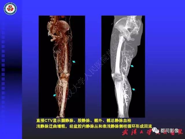 【PPT】下肢血管性病变CTA和MRA