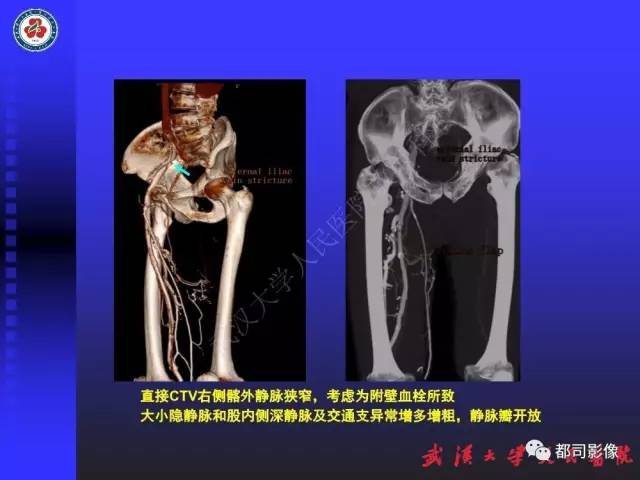 【PPT】下肢血管性病变CTA和MRA