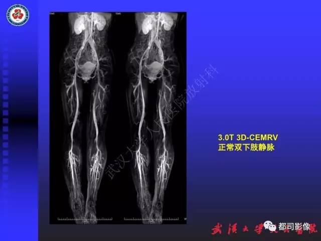 【PPT】下肢血管性病变CTA和MRA