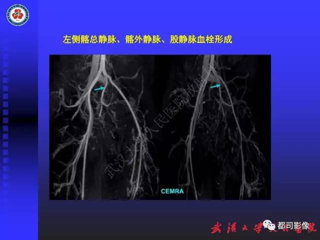 【PPT】下肢血管性病变CTA和MRA
