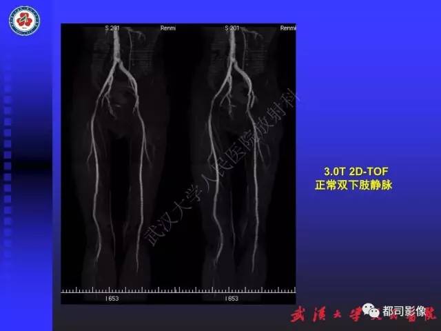 【PPT】下肢血管性病变CTA和MRA