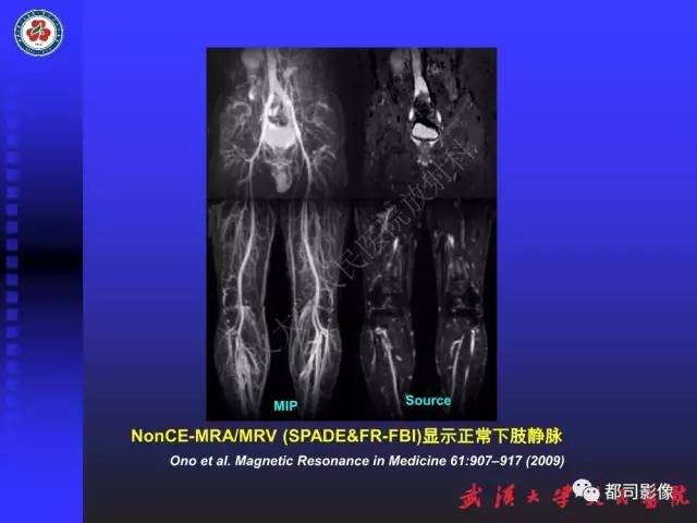 【PPT】下肢血管性病变CTA和MRA