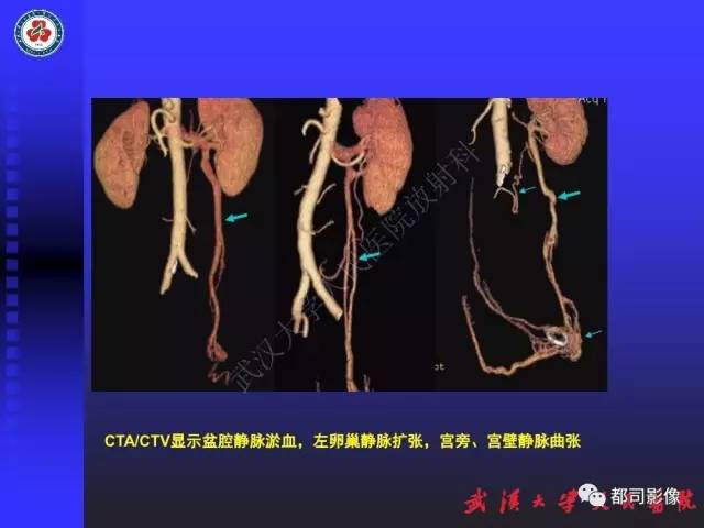 【PPT】下肢血管性病变CTA和MRA