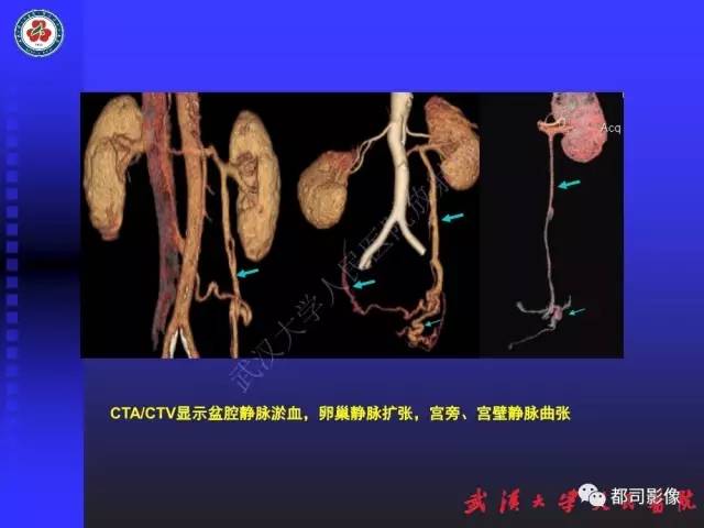 【PPT】下肢血管性病变CTA和MRA