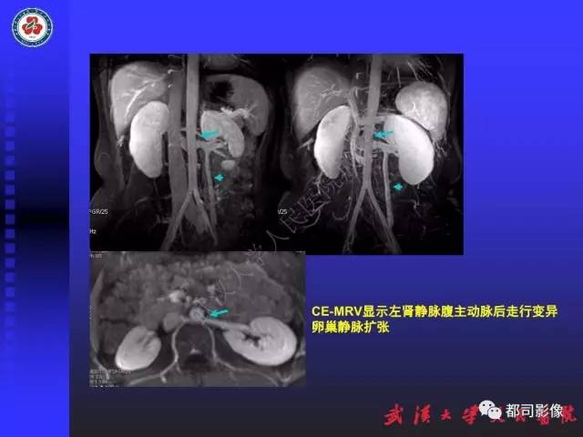 【PPT】下肢血管性病变CTA和MRA