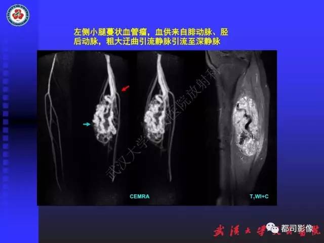 【PPT】下肢血管性病变CTA和MRA