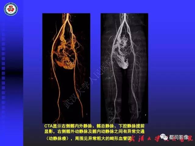 【PPT】下肢血管性病变CTA和MRA