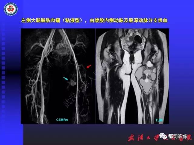 【PPT】下肢血管性病变CTA和MRA