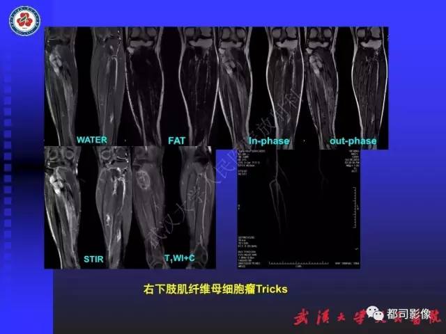 【PPT】下肢血管性病变CTA和MRA