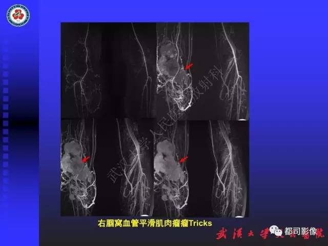 【PPT】下肢血管性病变CTA和MRA