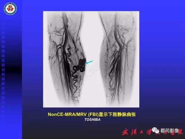 【PPT】下肢血管性病变CTA和MRA