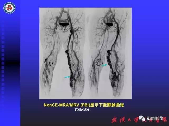 【PPT】下肢血管性病变CTA和MRA