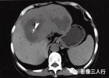 【病例】肝孤立性纤维瘤1例CT影像分析