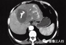 【病例】肝孤立性纤维瘤1例CT影像分析 【病例】肝孤立性纤维瘤1例CT影像分析