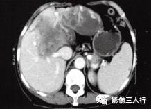 【病例】肝孤立性纤维瘤1例CT影像分析 【病例】肝孤立性纤维瘤1例CT影像分析