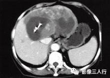 【病例】肝孤立性纤维瘤1例CT影像分析 【病例】肝孤立性纤维瘤1例CT影像分析
