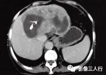 【病例】肝孤立性纤维瘤1例CT影像分析 【病例】肝孤立性纤维瘤1例CT影像分析