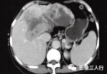 【病例】肝孤立性纤维瘤1例CT影像分析 【病例】肝孤立性纤维瘤1例CT影像分析