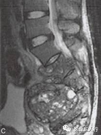 【病例】腰骶段脊索瘤1例MR影像分析